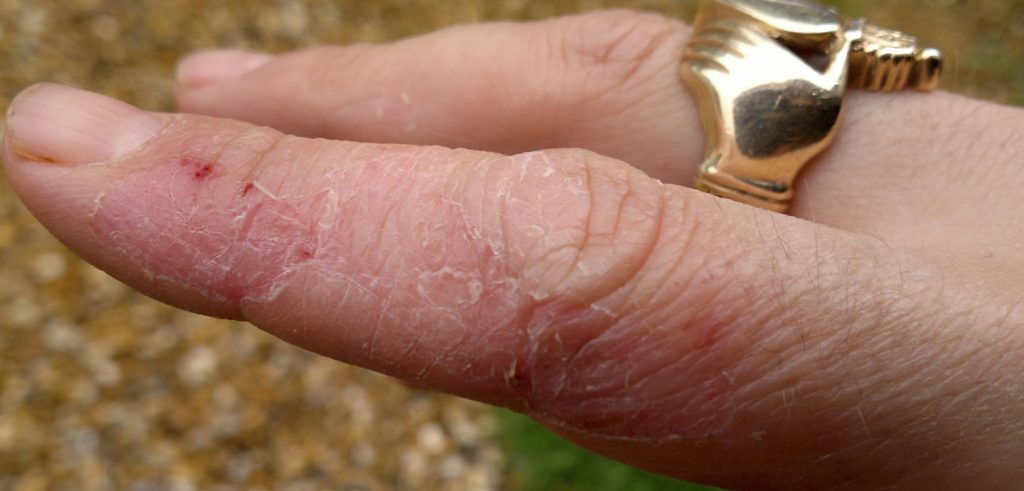 Una mano con eczema (foto: davefarmersblog.wordpress.com)
