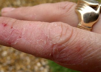 Una mano con eczema (foto: davefarmersblog.wordpress.com)